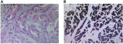 Frontiers Successful Treatment Of A Patient With Advanced Lung